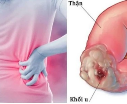 Béo phì và nguy cơ ung thư thận